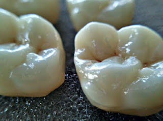 porselen diş kırılması