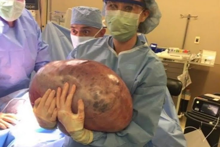 Incredibile gigantesca cisti ovarica di 23 chili.