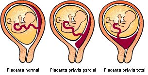 Placenta prévia