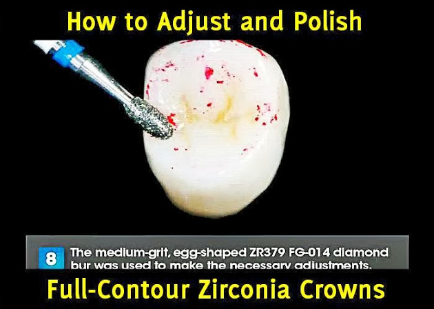 ZIRCONIA CROWNS: How to Adjust and Polish Full-Contour