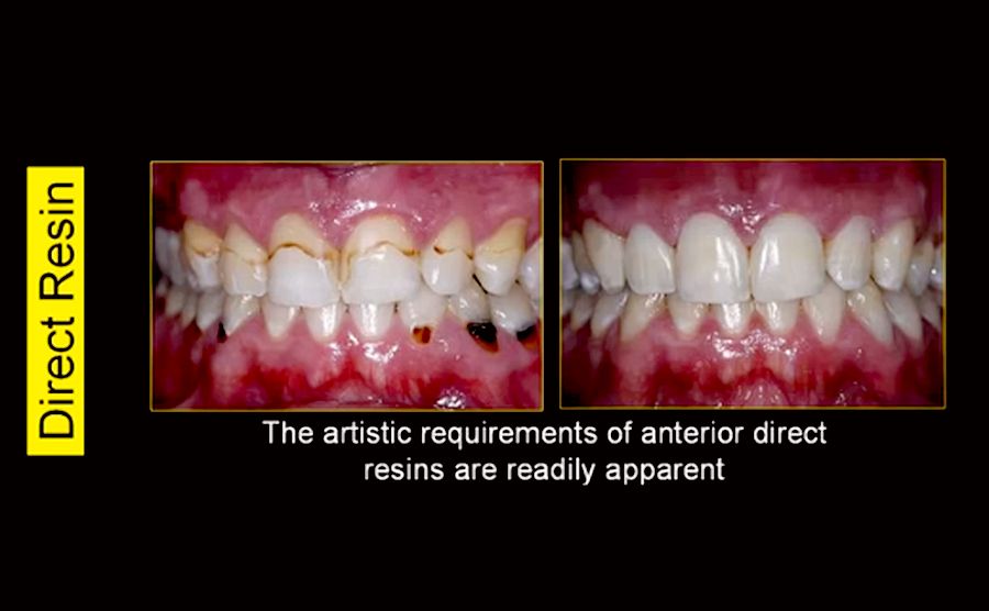 OPERATIVE DENTISTRY Anterior Composite Videoconferencing of Dr. Michael