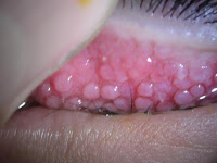papilas gigantes alergia ocular