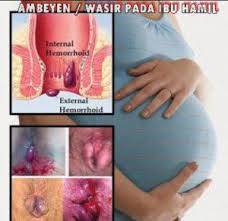 Foto Obat Untuk Ambeien Dan Wasir Pada Ibu Hamil