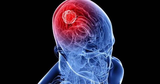Adult brain tumors can suggest Commit error. adult brain tumors how