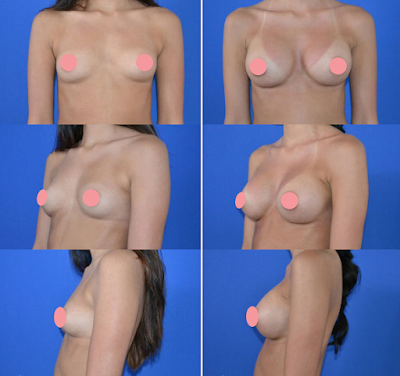 Antes e Depois Mamoplastia de Aumento Antes e Depois Mamoplastia de Aumento