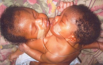 Conjoined Twins With 1 Liver, 1 kidney & 1 intestine born to Abuja Jobless Couple 1