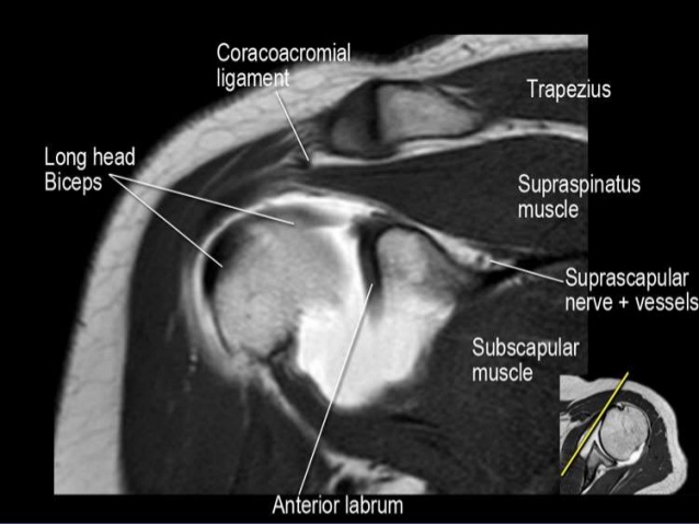 MRI Musculo-Skeletal Section: MRI anatomy of the shoulder (coronal view)