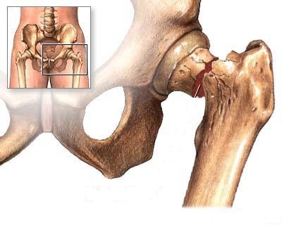 Tratamentul Osteoporozei