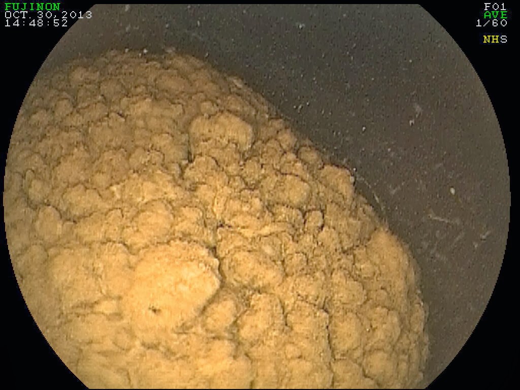 Michael Porter, Equine Veterinarian Urinary Bladder Stone in a Horse