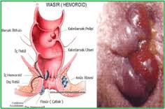 Obat Nya Ambeien Yang Alami Dan Ampuh Obat Nya Ambeien Yang Alami Dan Ampuh