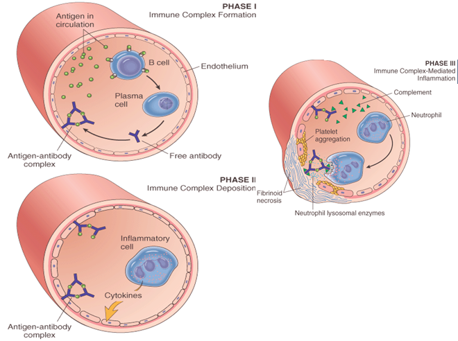 Type III Hypersensitivity