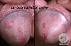 Obat Sifilis Untuk Pria Obat Sifilis Untuk Pria