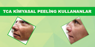 TCA Kimyasal Peeling Kullananlar TCA Kimyasal Peeling Kullananlar