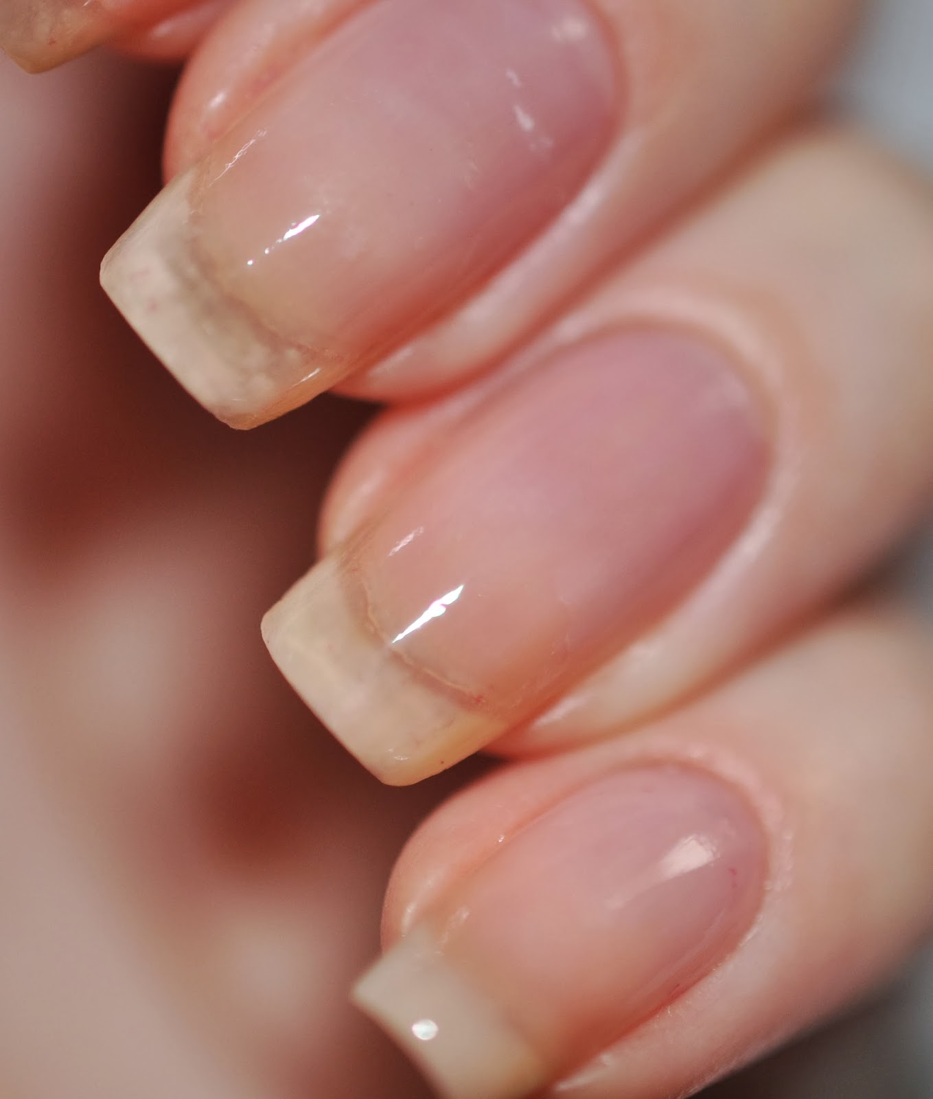 Ноготь отходит от ложа как лечить. Ноготь отходит от ложа как лечить. Онихолитический онихомикоз. Дерматологический онихолизис. Ноготь отходит от ложа как лечить.