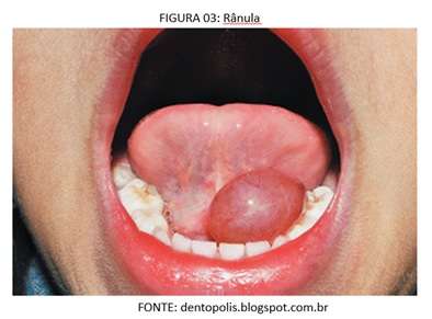 Mucocele labial cie 10