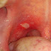 10 best home remedies of mouth ulcer