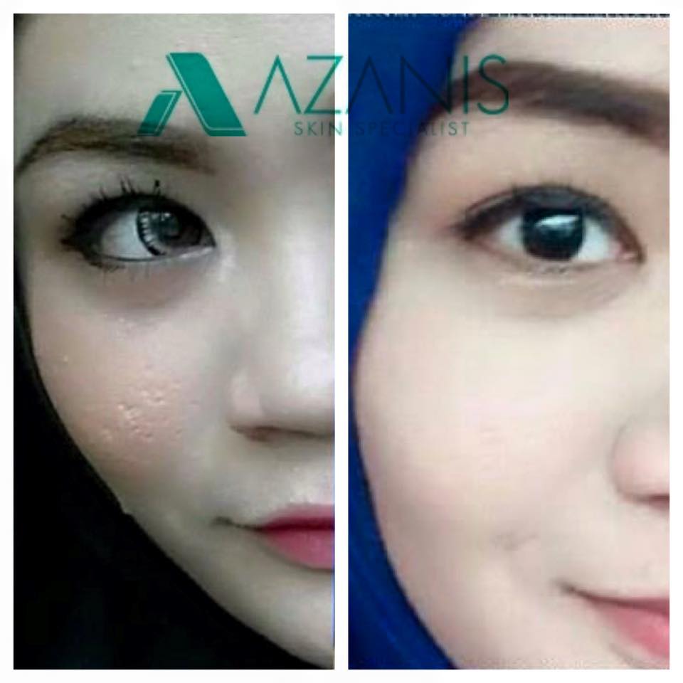 Serum Azanis zialisha house azanis scar serum Serum Azanis zialisha house azanis scar serum