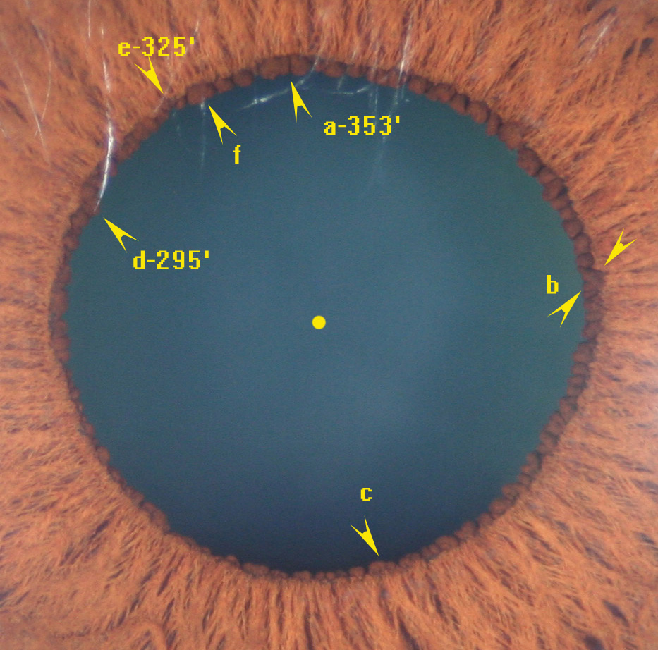 modern-multidimensional-iridology-ipb-morphologies-space-risk