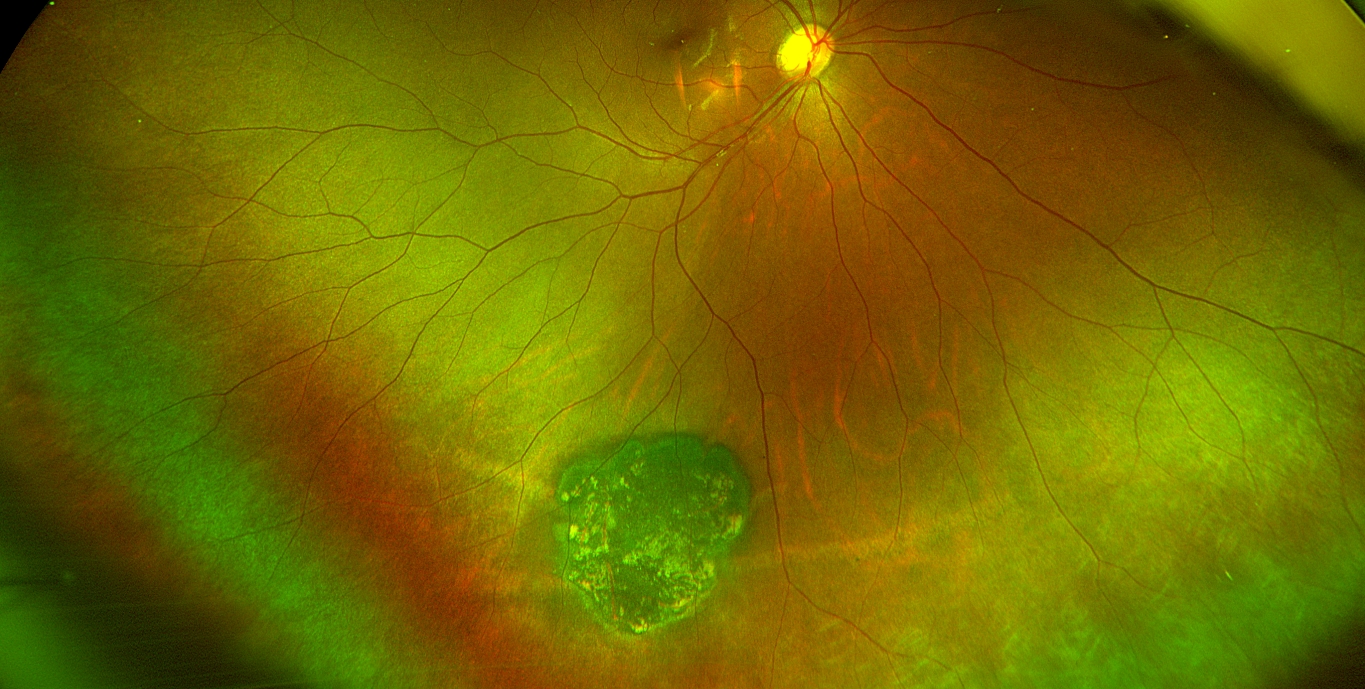 Sonoran Desert Eye Center CONGENITAL HYPERTROPHY OF THE RETINAL