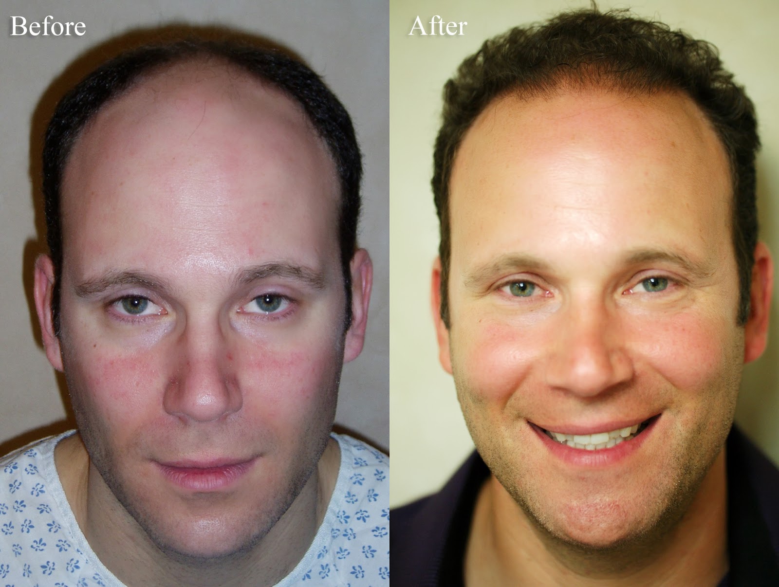 Neiman Dermatology and Hair Transplantation Hair Transplant Results by