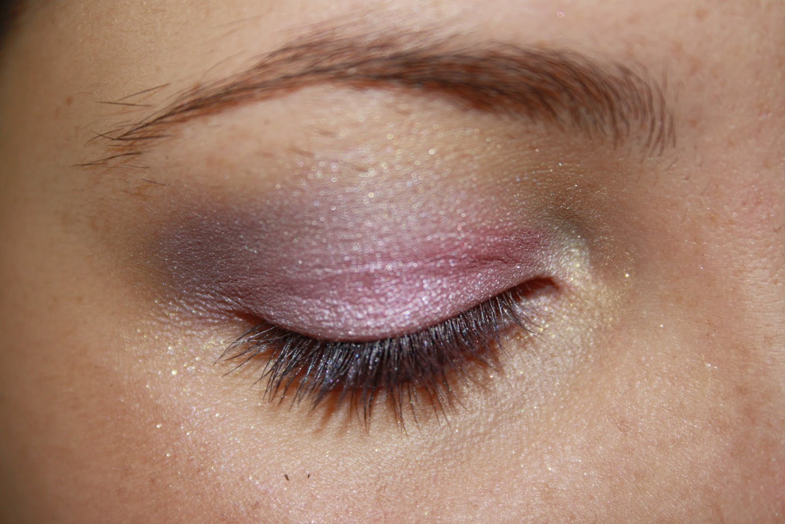 psoriasis eyelid