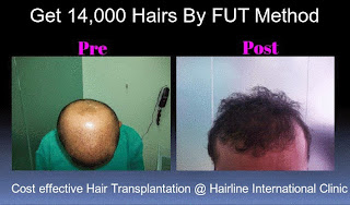  Hair Transplantation in Bangalore