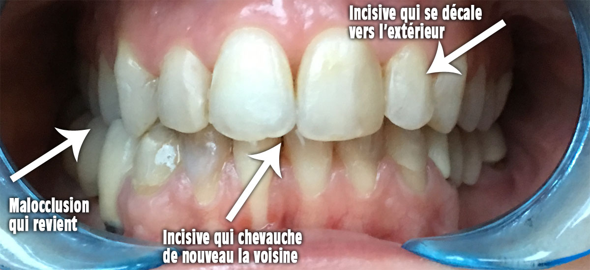 Orthodontie adulte bouche en chantier 2 ans postopératoire et 3 mois post débaguage