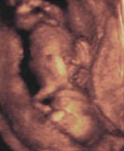 Hafta hafta bebeğin ultrason görüntüleri-15.hafta