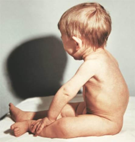 बच्चों के सूखा रोग के लिए आयुर्वेदिक उपचार 