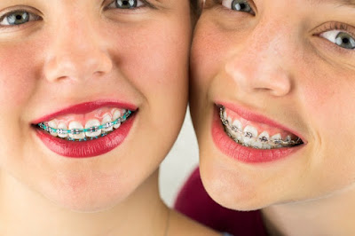 Niềng răng lộn xộn và hàm nhô có ảnh hưởng gì?