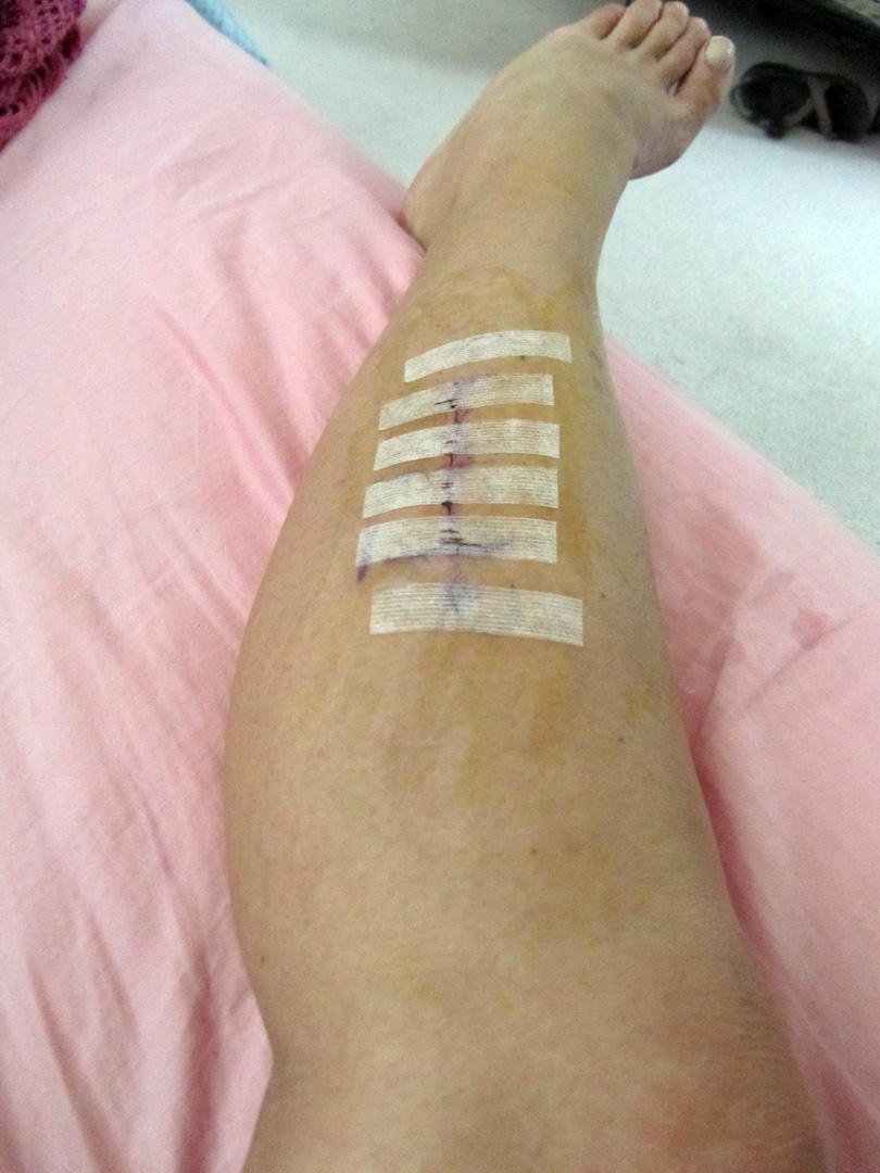 My Experience With Chronic Exertional Compartment Syndrome My Progress
