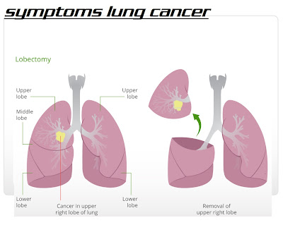 image lung cancer symptoms | picture of lung cancer | cancer in upper right lobe of lung | sample cancer of lung | how to cancer of lung