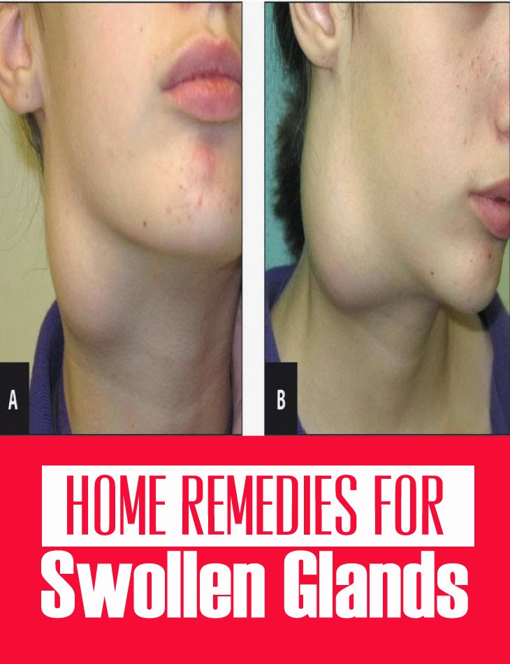 Home Remedies for Swollen Glands Cute Health