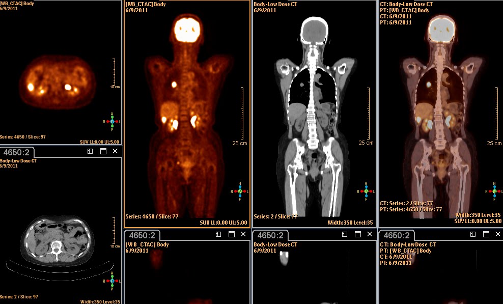 Dokter Gondok Anda Semua: PET CT MRCCC
