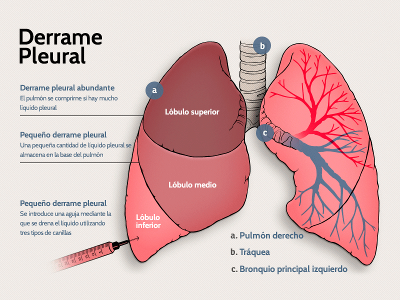 EL RINCON DE ELY DERRAME PLEURAL