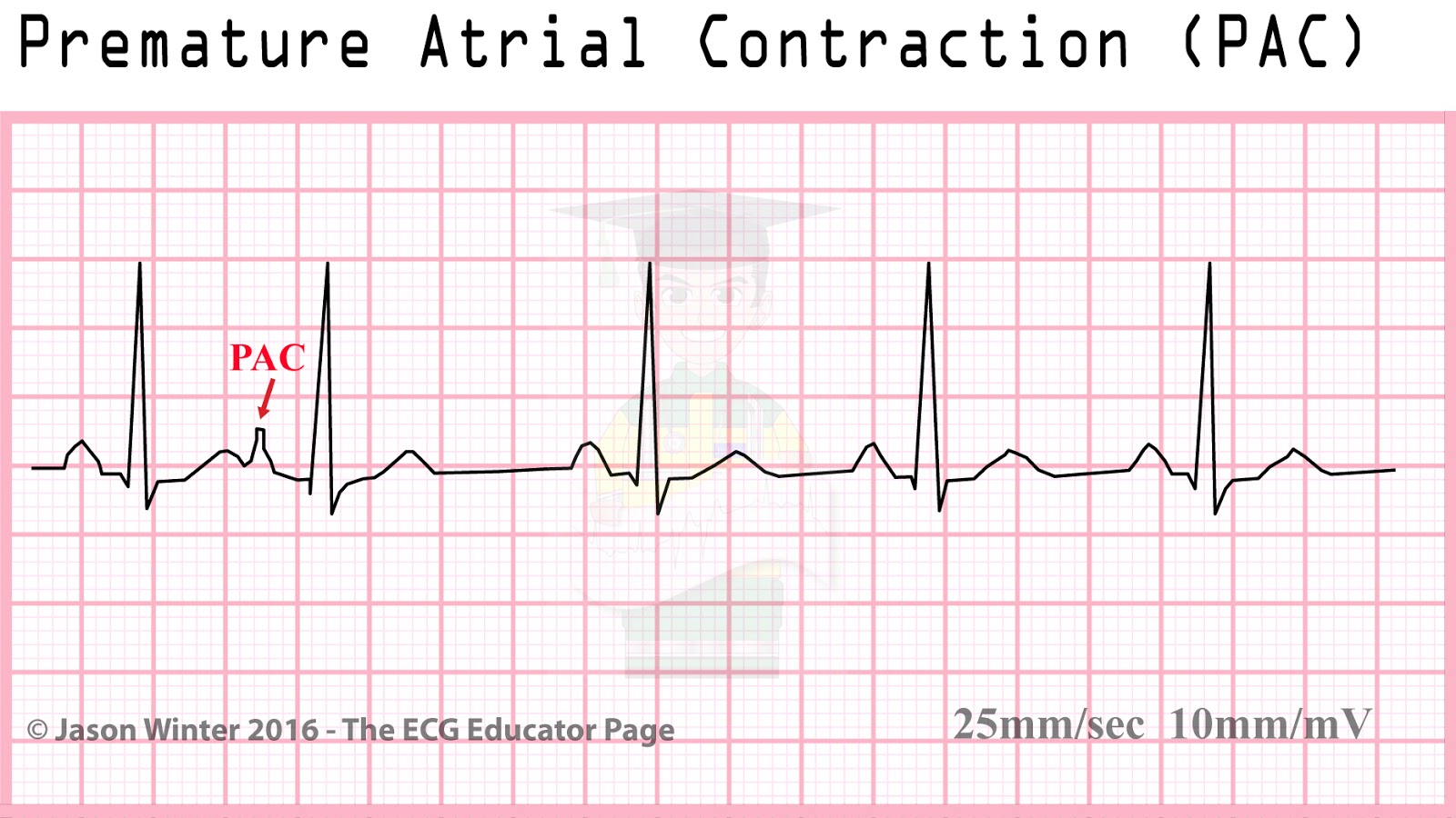 Premature Ventricular Contraction Ecg Tutorial Images