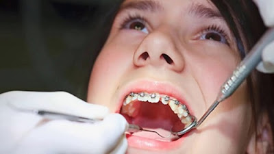 Bác sĩ phân tích răng khểnh có nên niềng không 2
