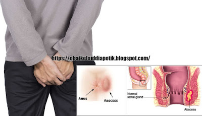 Obat Herbal Abses Di Anus Tanpa Operasi