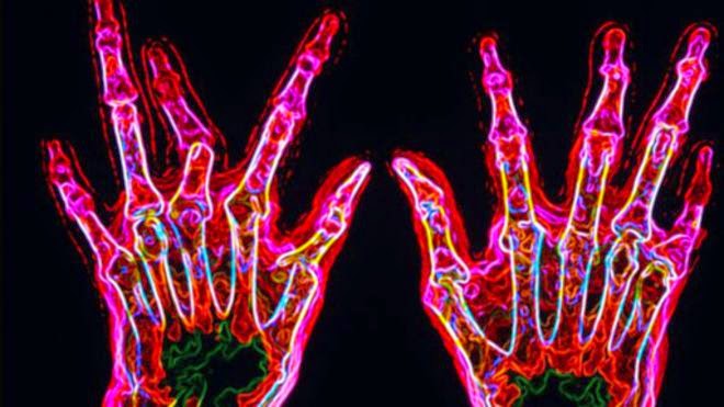 類風濕性關節炎 植入儀器刺激神經減輕痛楚