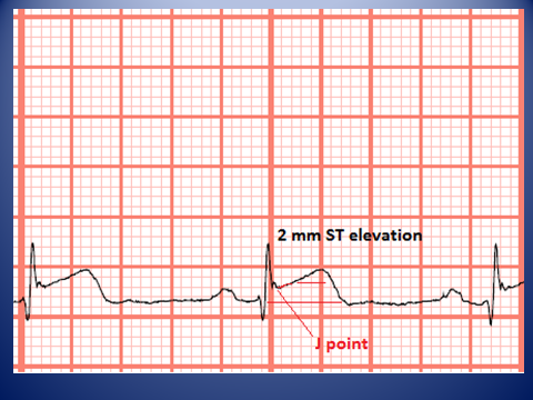 telemetry technician course measuring st elevation and ekg graph paper