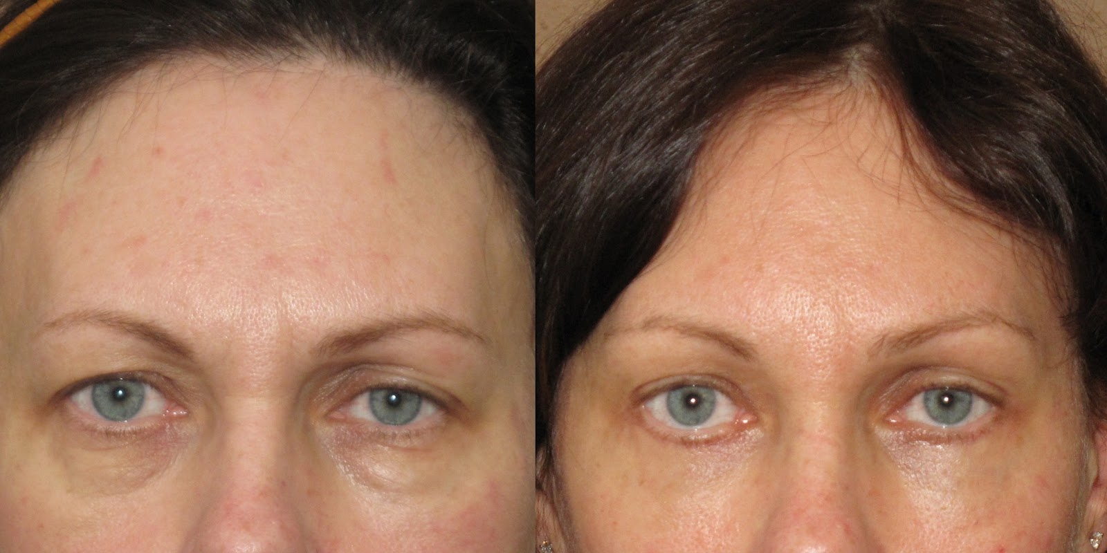 New Horizons Plastic Surgery Reversing Aging Of The Eyes Smart And 