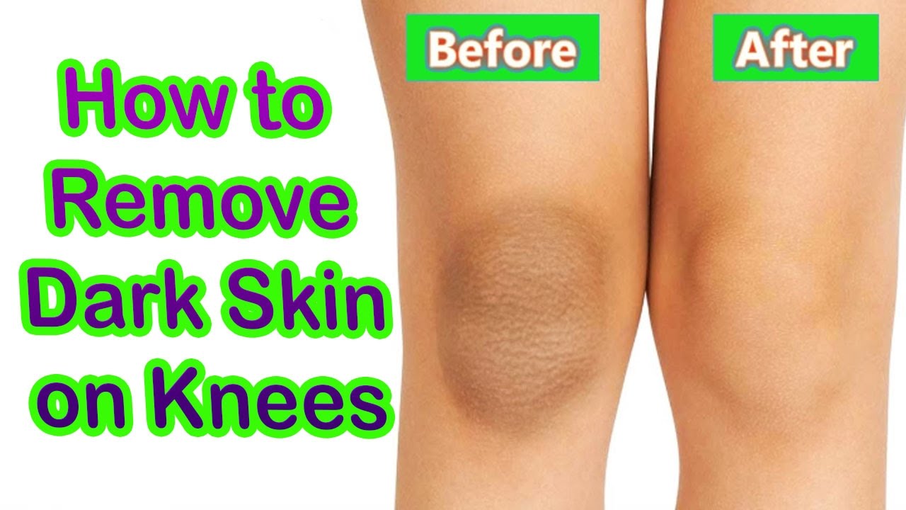 get-rid-of-elbows-and-knees-black-spots-in-just-4-steps-health-and