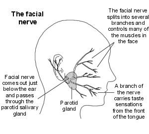 Acoustic Neuroma Facial Nerve 45