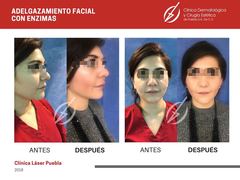 Adelgazar cachetes cirugia sin Adelgazar cachetes cirugia sin