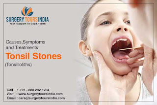 Tonsil Stones Treatment In India