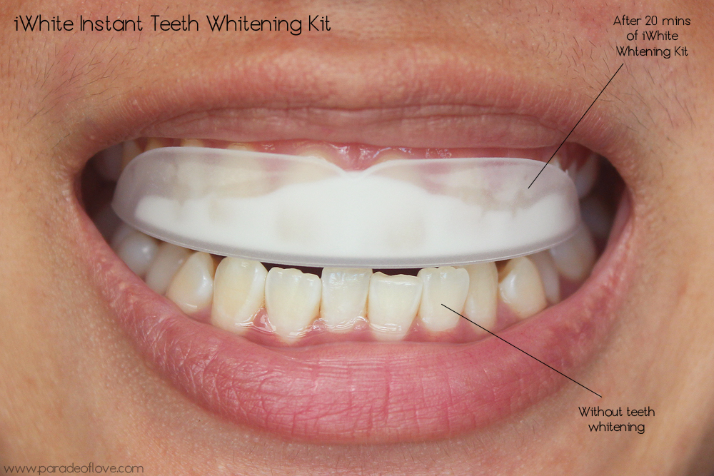 klem medaillewinnaar Vochtig iWhite Instant Teeth Whitening Review : Roanna Tan | Paradeoflove