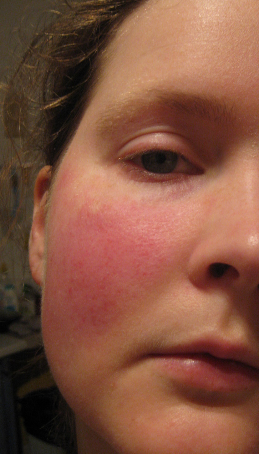 Scarlet Letters, dealing with vascular rosacea, face flushing, burning
