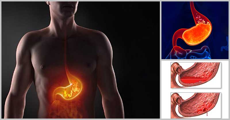 Effective Natural Remedies For Hyperacidity Dr Farrah MD Effective Natural Remedies For Hyperacidity Dr Farrah MD