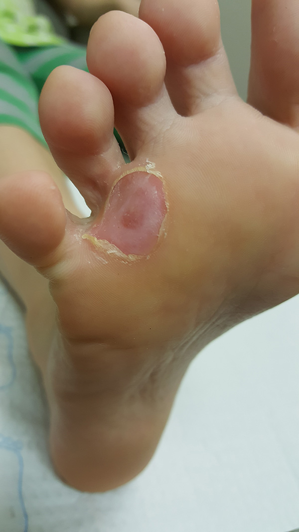 My Plantar Wart Treatment Experience