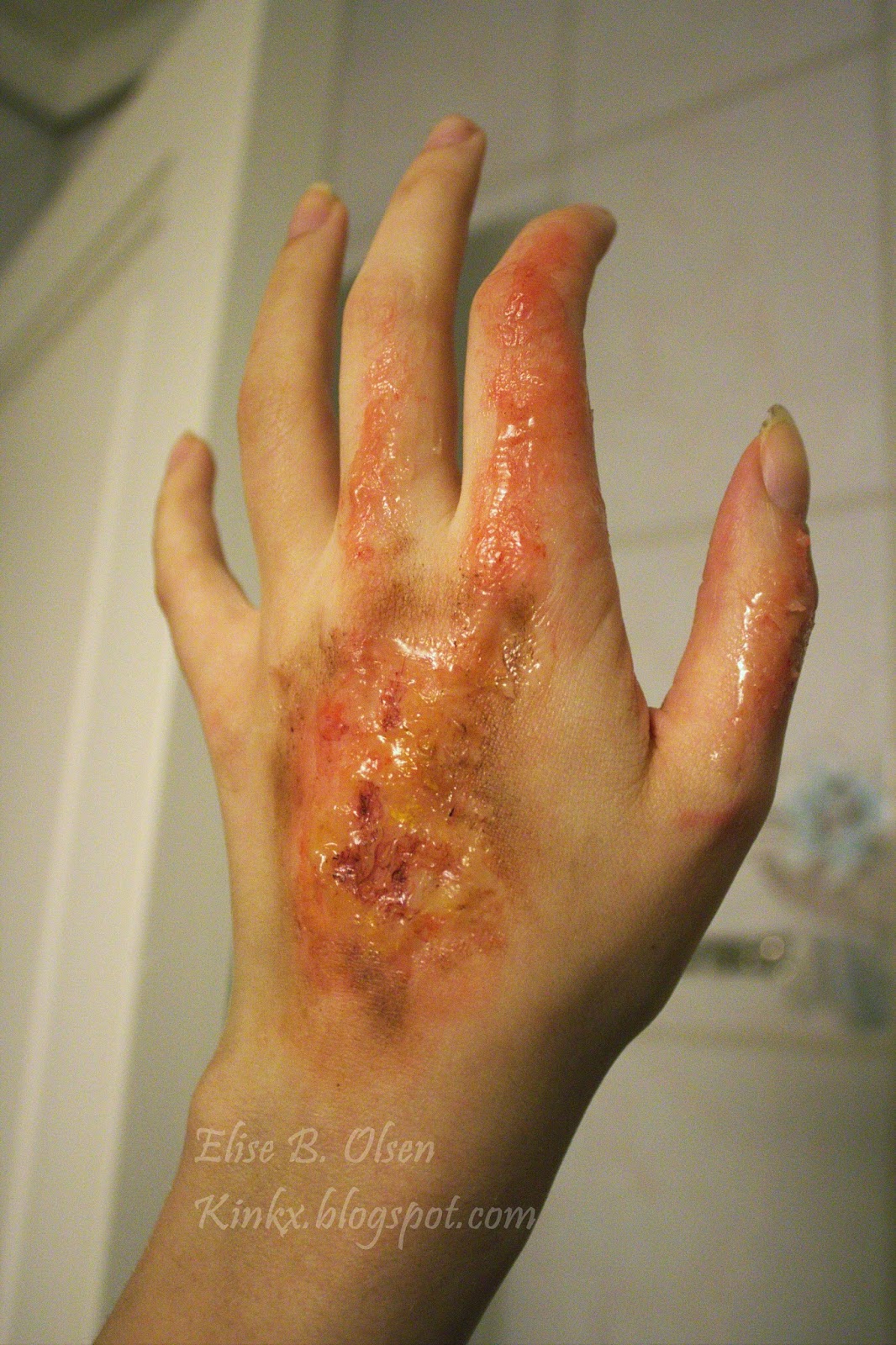 3rd degree burn 3rd degree burn